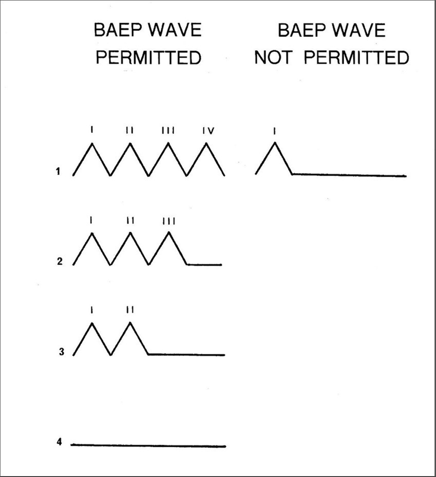 Schematic illustration of the four waveforms which are compatible with the new version of BAEP generation and the one which is not.