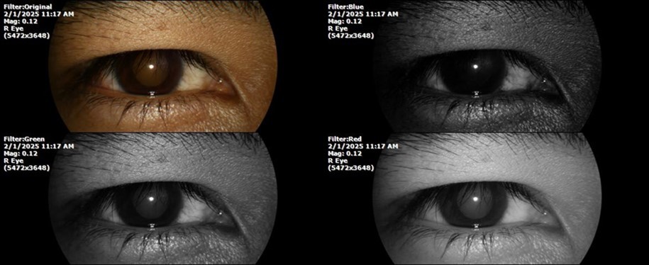 The photograph shows better specular reflection, compared to the first day of the exam.