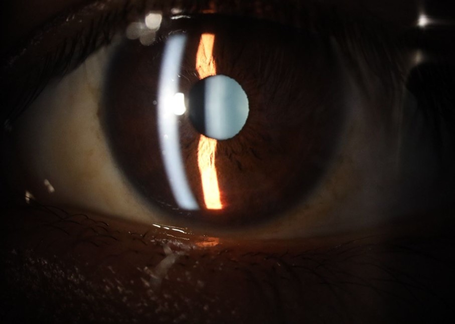 The anatomy of the anterior segment of the left eye is shown without alterations.