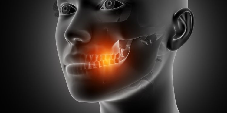 Journal of Otolaryngology Advances - Radio-Induced Maxillary